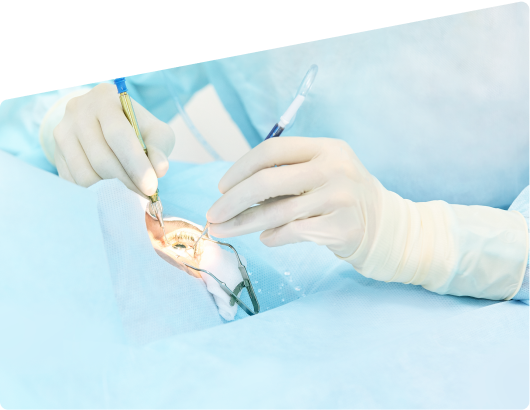 cataract surgery