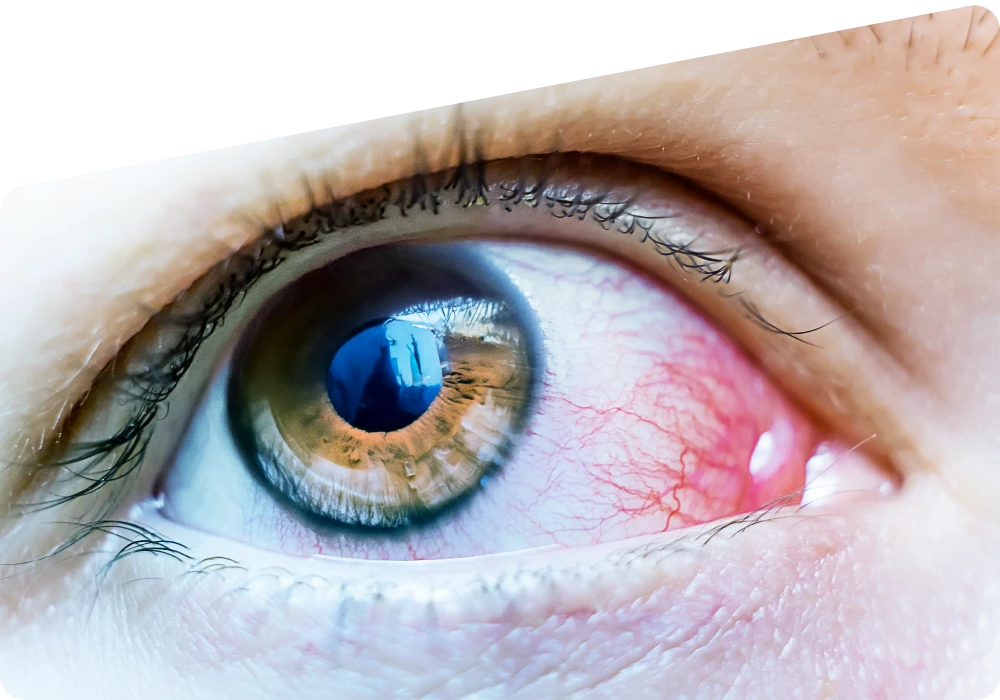 Diabetic Retinopathy: Causes, Diagnosis, and Care