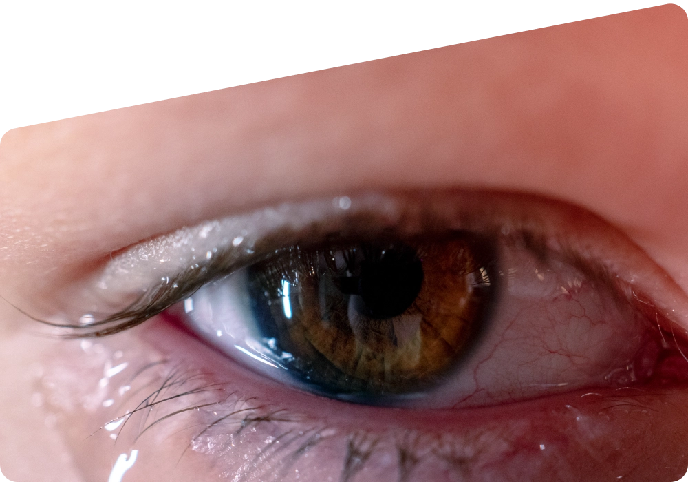 Watery Eyes: Causes, Epiphora and Treatment