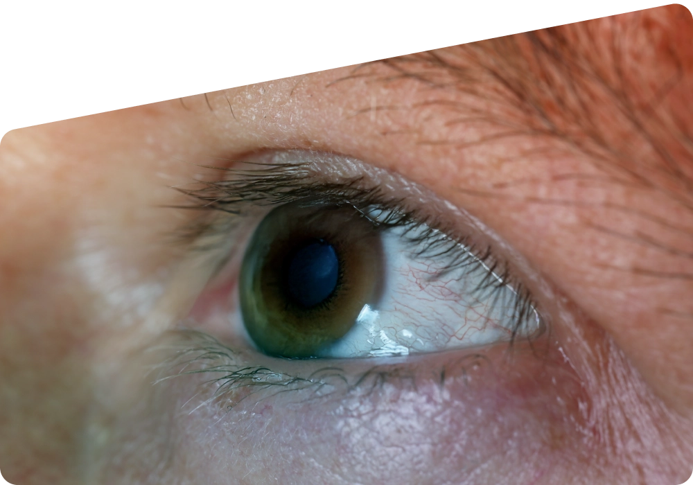 7 Keratoconus Treatments by Severity