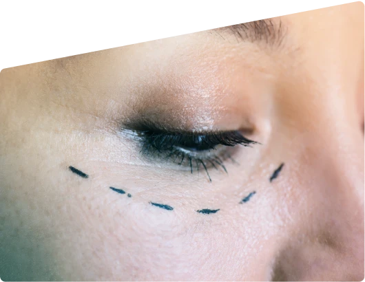 eyelid surgery dubai
